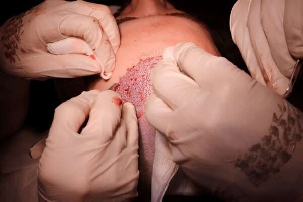 hair transplant UK