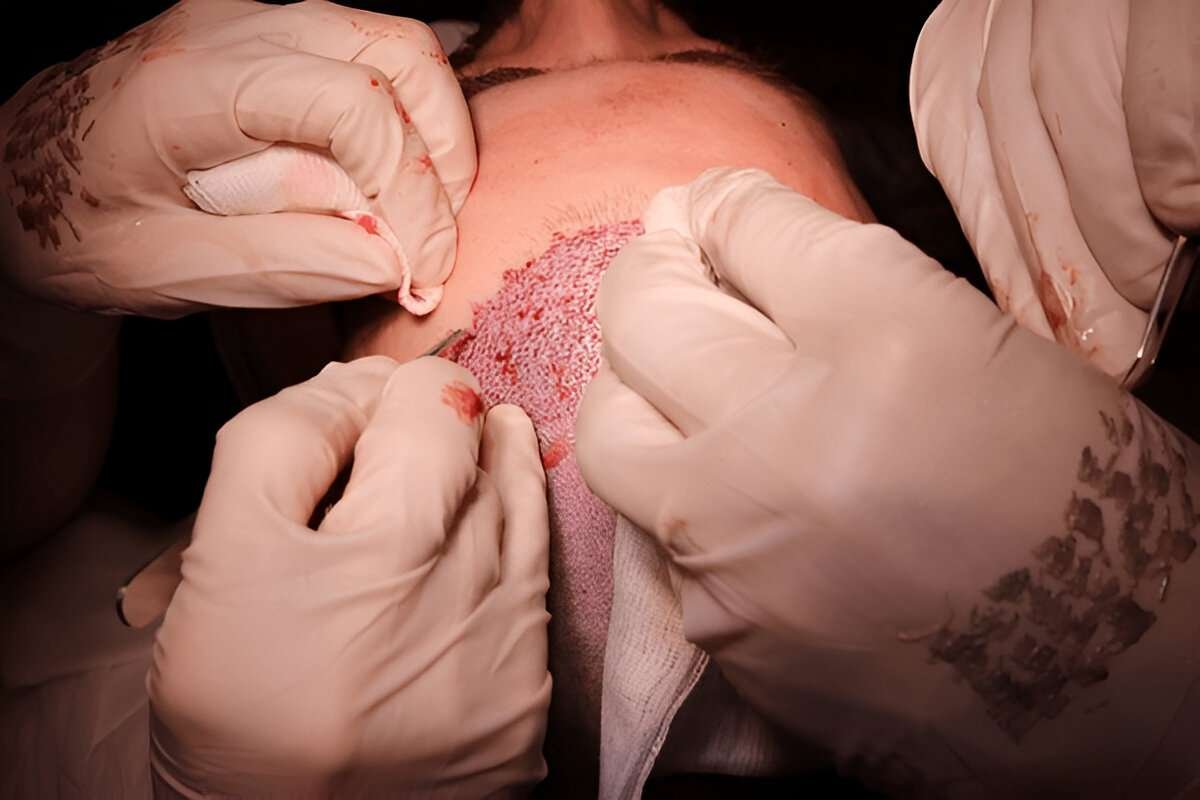 hair transplant UK