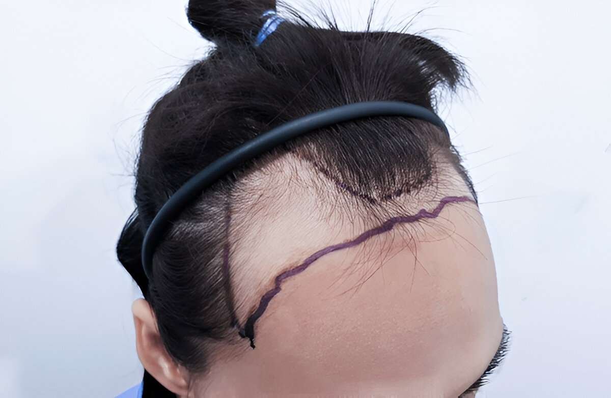hair transplant