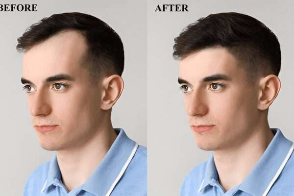 Hair Transplant