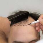 hair transplant Manchester
