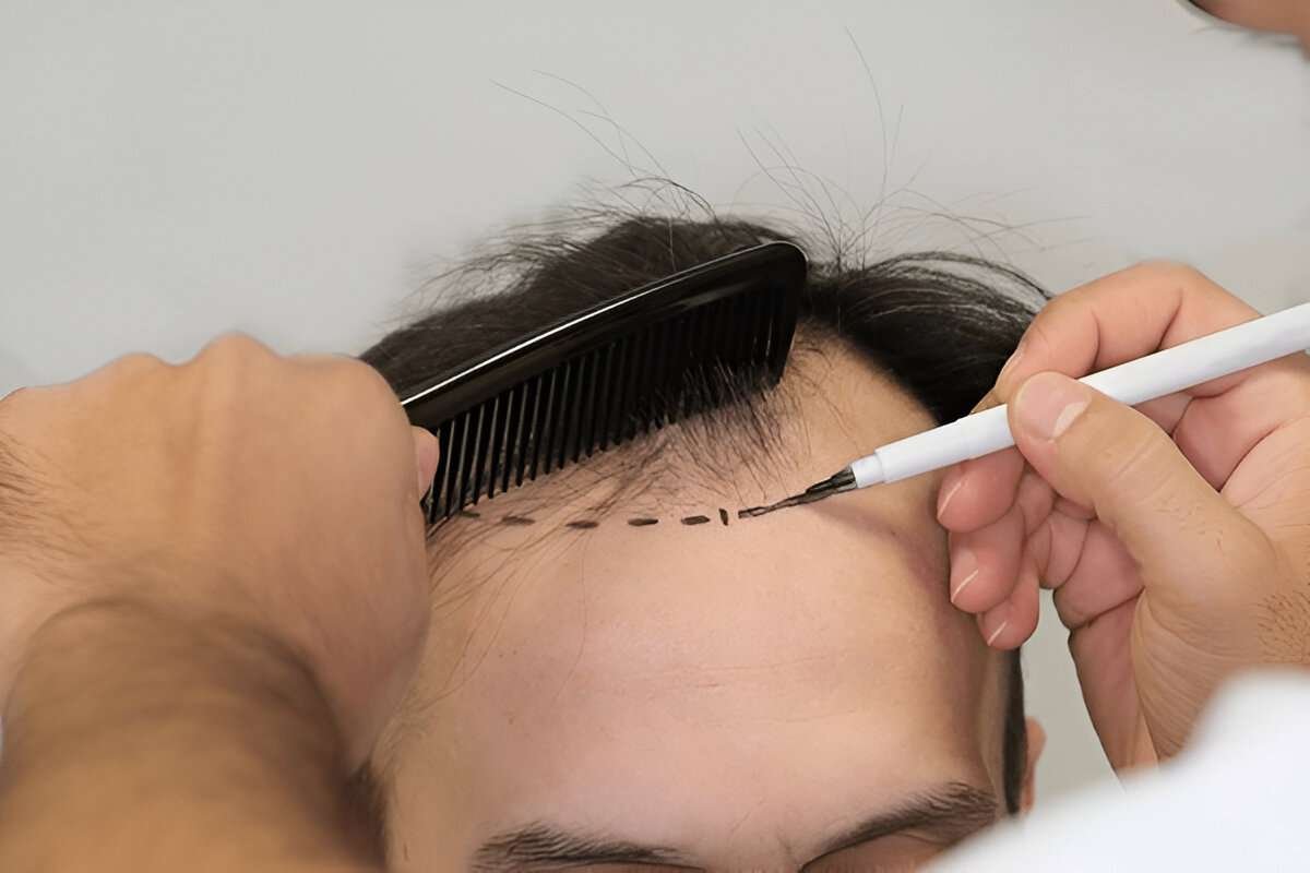 hair transplant Manchester