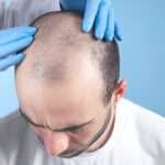 Why Some Hair Transplants Fail and How to Avoid It hair transplant Cardiff