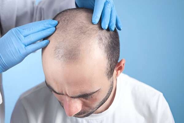 Why Some Hair Transplants Fail and How to Avoid It hair transplant Cardiff