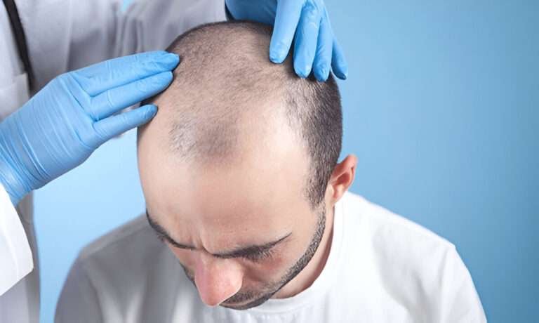 hair transplant Cardiff
