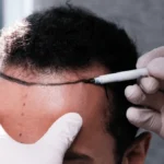 hair transplant