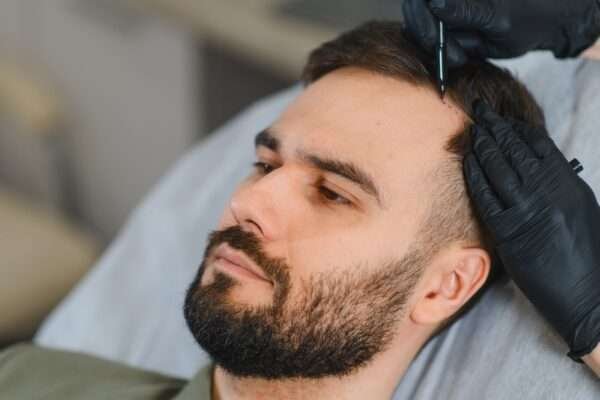 finasteride vs minoxidil