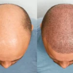 seborrhoeic Dermatitis