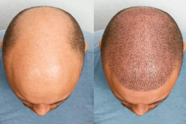 seborrhoeic Dermatitis