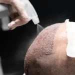 hairloss treatment