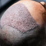 receding hairline