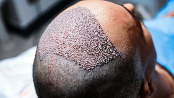 receding hairline
