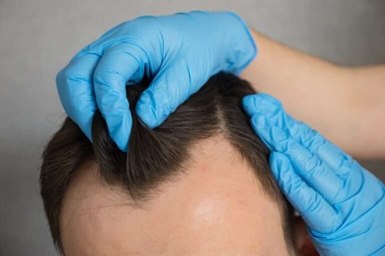 rob brydon hair transplant