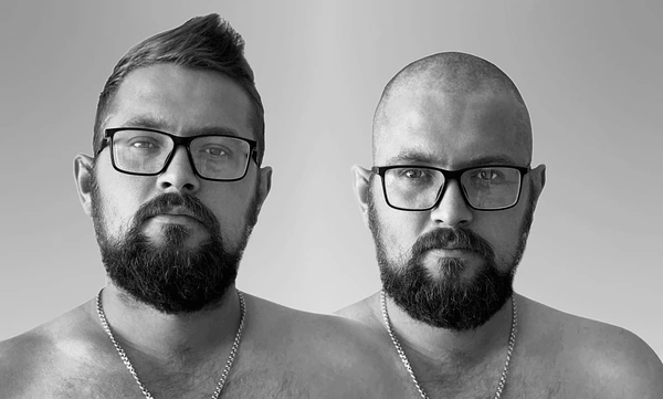 finasteride before and after